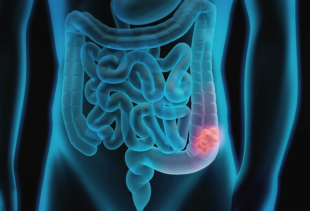 Best Surgeon for Intestinal Obstruction in Pune Dr. Sandhya Bade