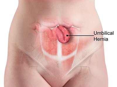 Umbilical Hernia Surgery in Pune by Dr. Sandhya Bade