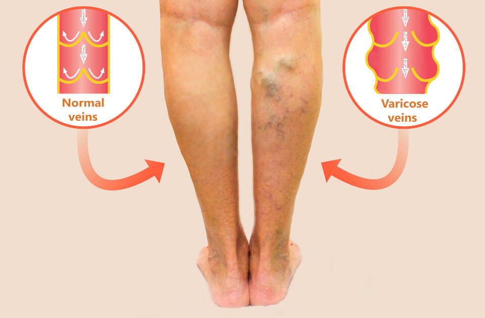 Top Laser Treatment For Varicose Veins in Pune